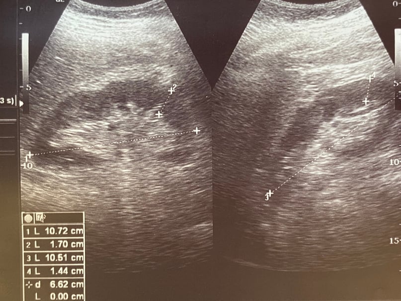 Kidney ultrasound